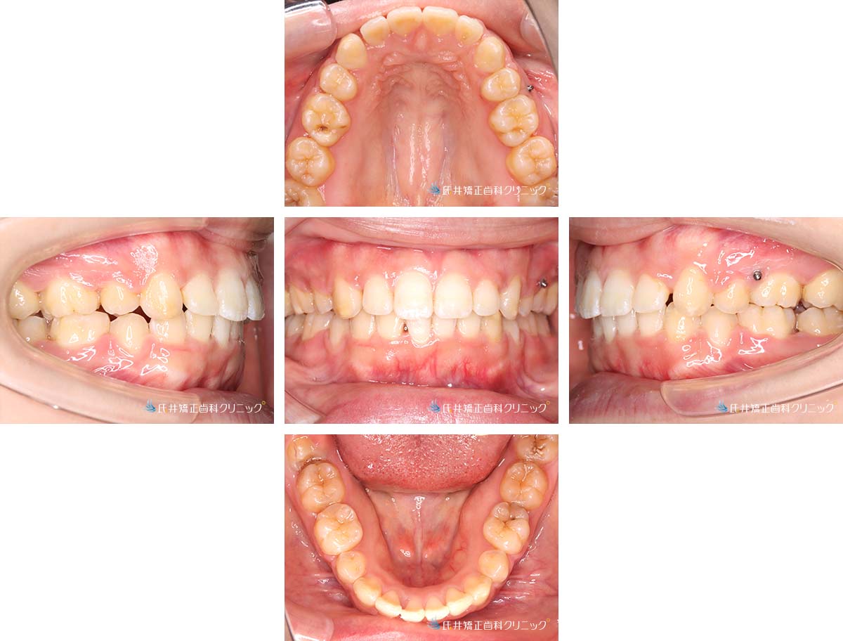治療中(1年2ヶ月後)