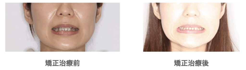 八重歯ハーフリンガル