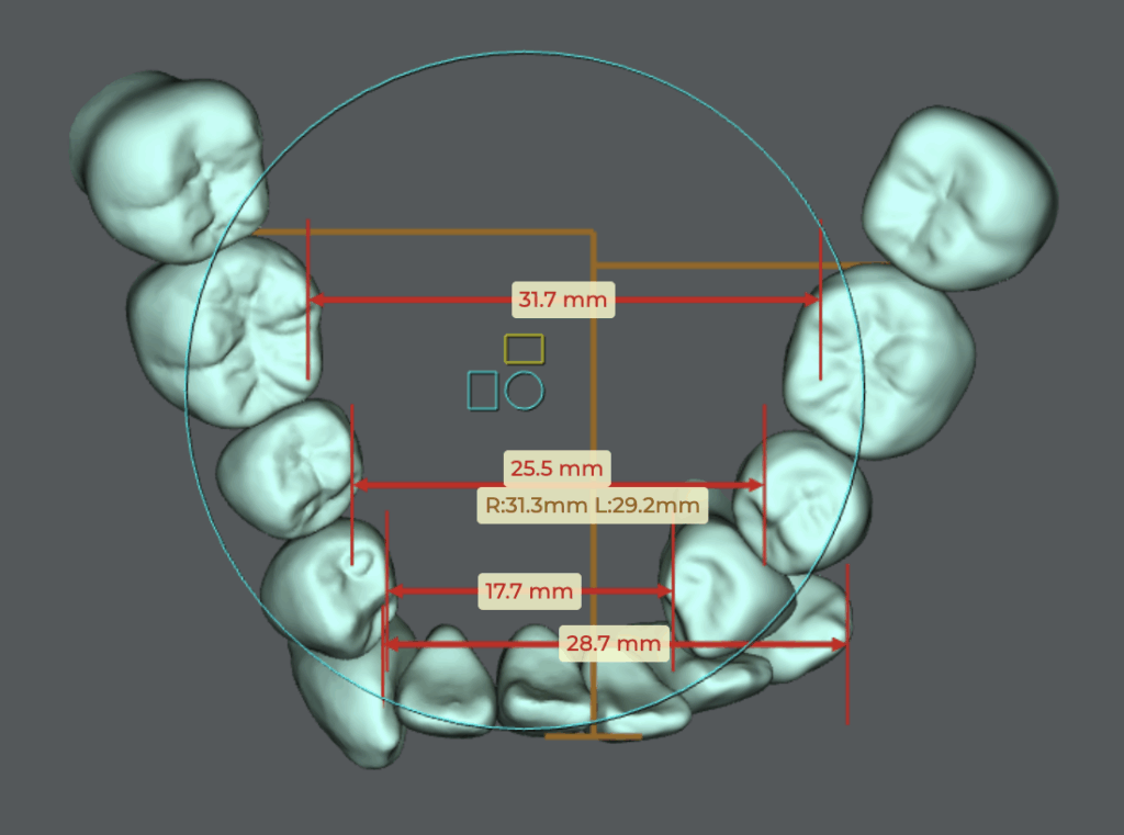 3Dスキャンによる八重歯の歯列模型|上下の噛み合わせと歯並びの状態を立体的に確認