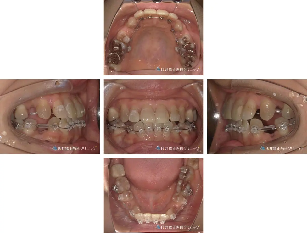 八重歯ハーフリンガル