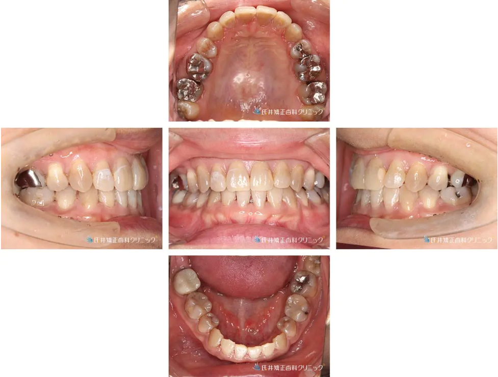 八重歯ハーフリンガル