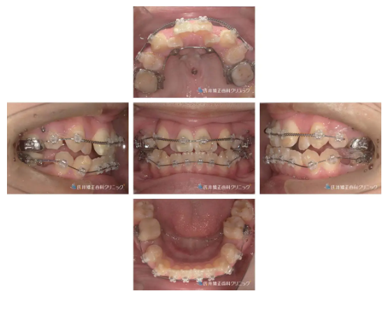 矯正治療 症例