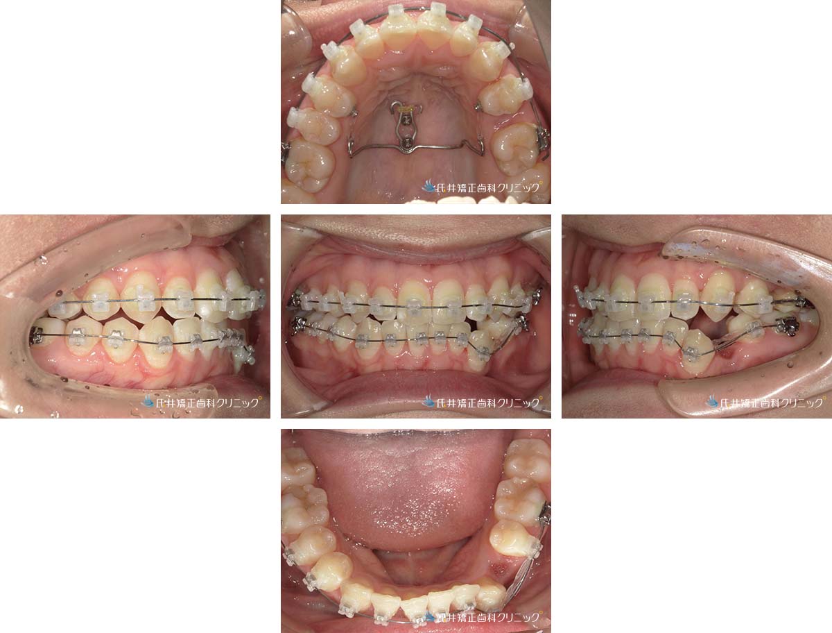 治療中（4ヶ月後）