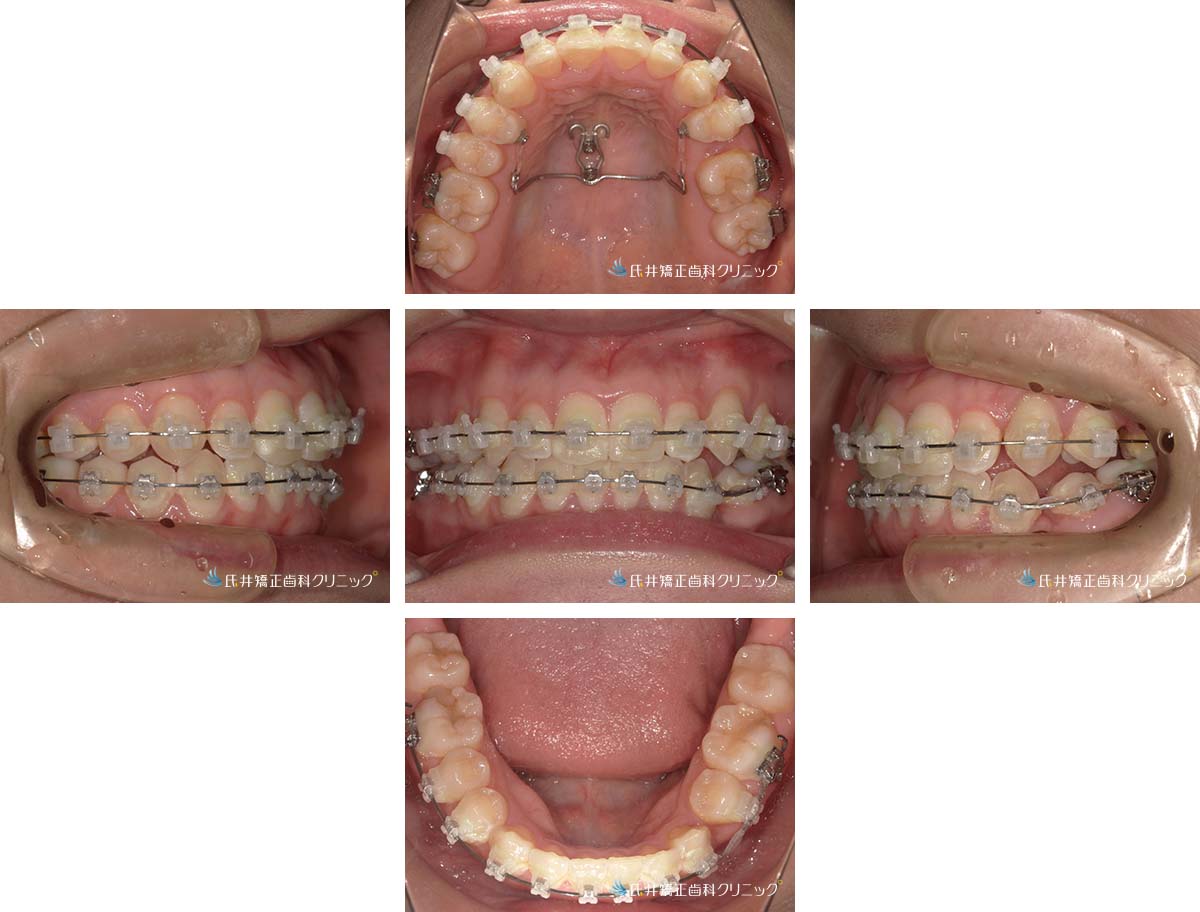 治療中（7ヶ月後）