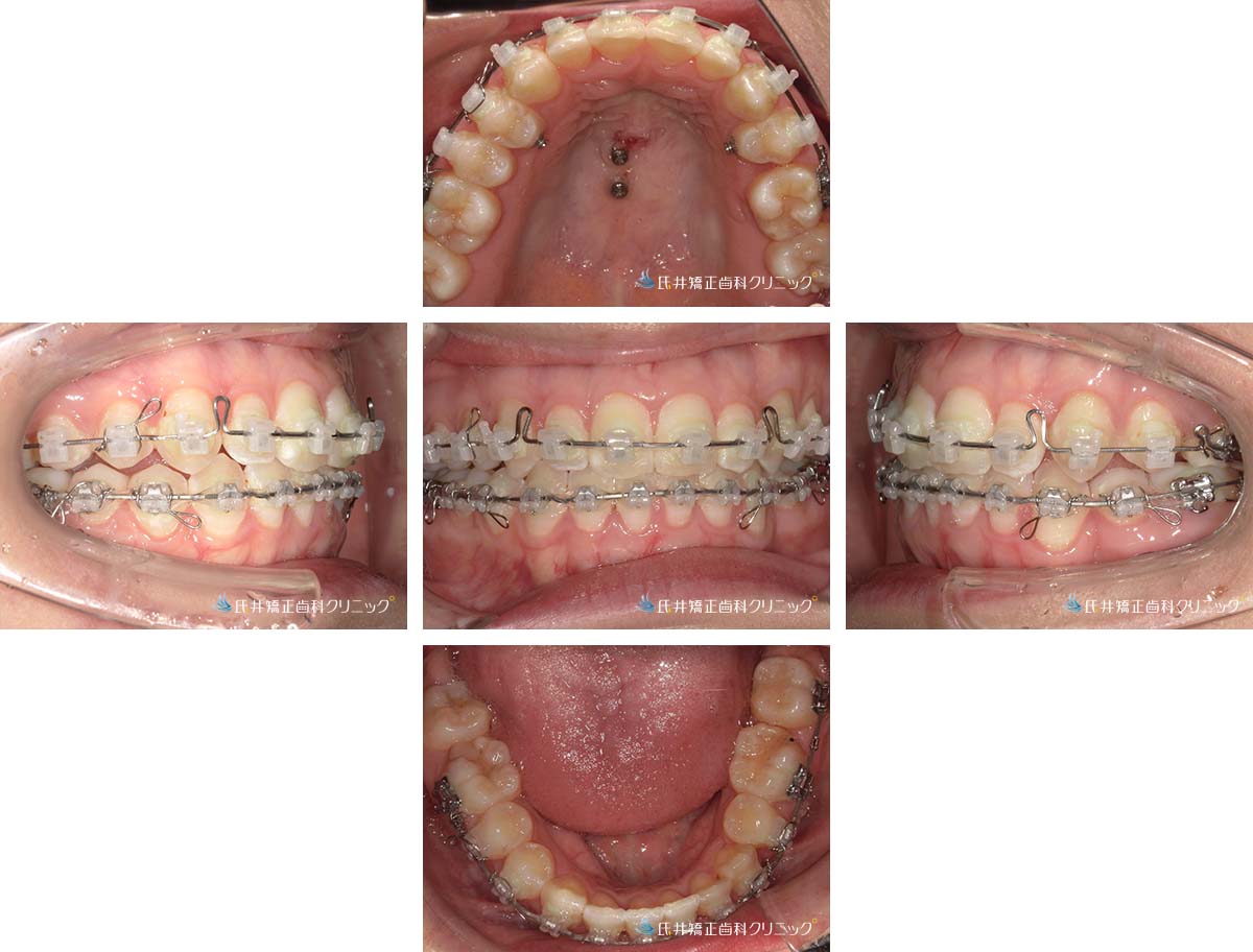 治療中（12ヶ月後）