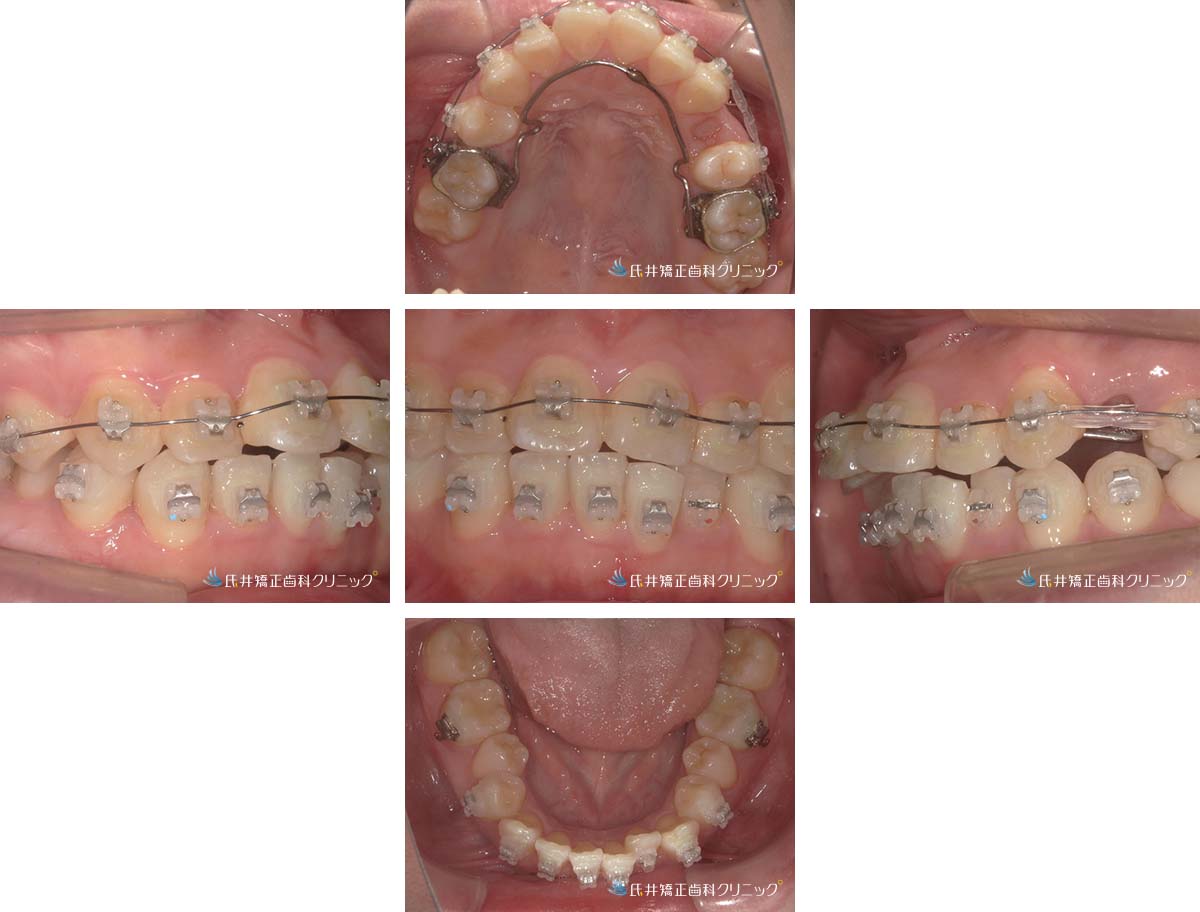 治療中（6ヶ月後）