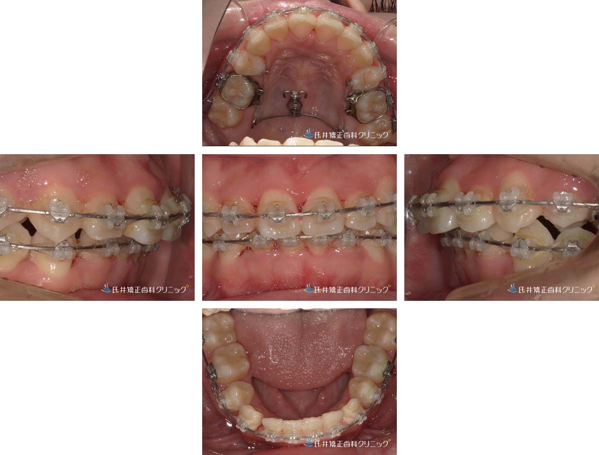 治療中（18ヶ月後）