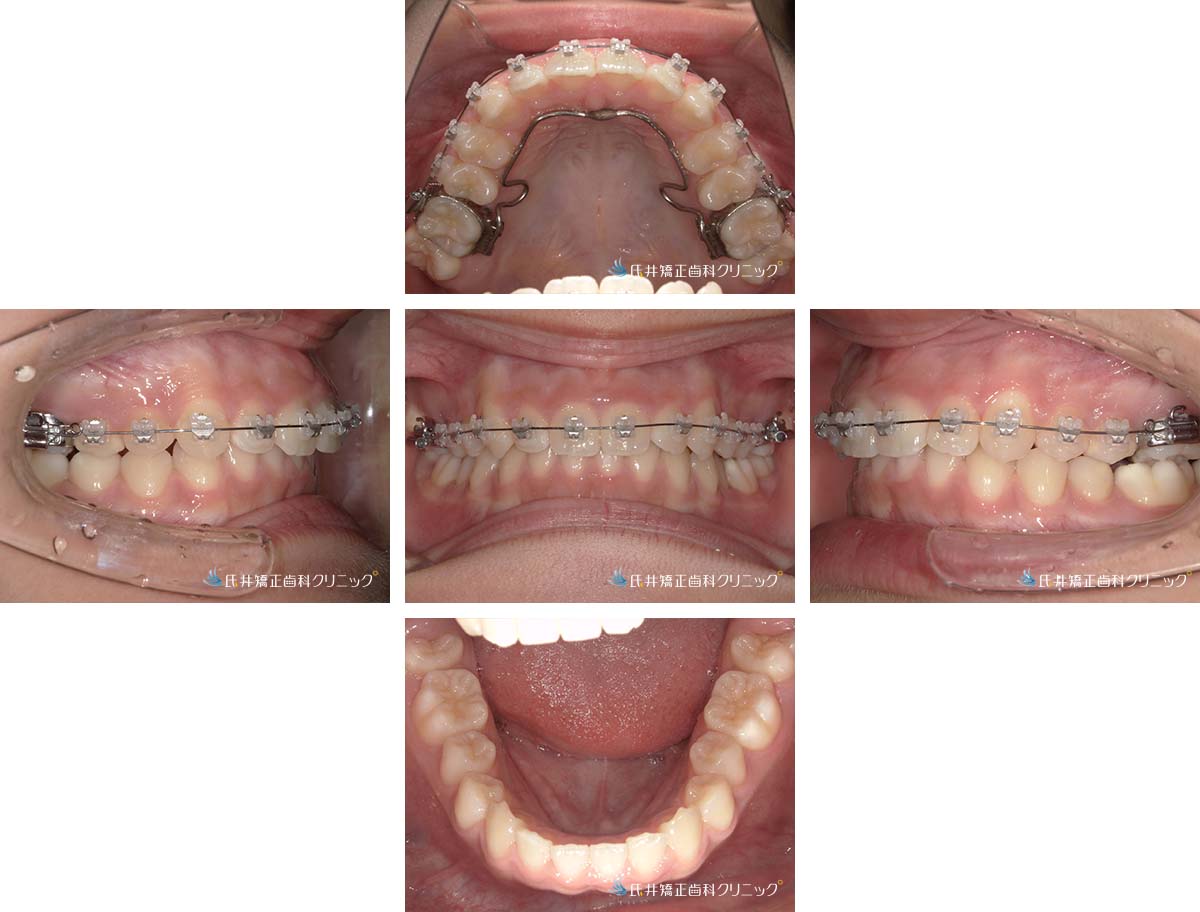 治療中（6ヶ月後）
