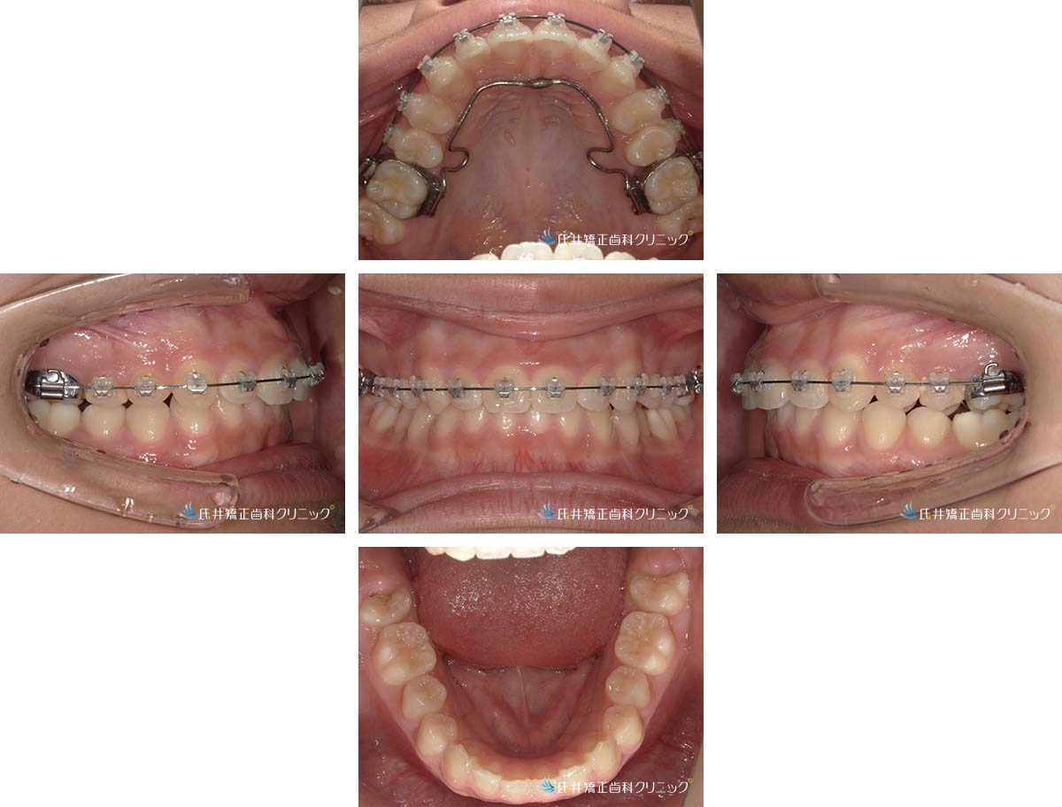治療中（8ヶ月後）