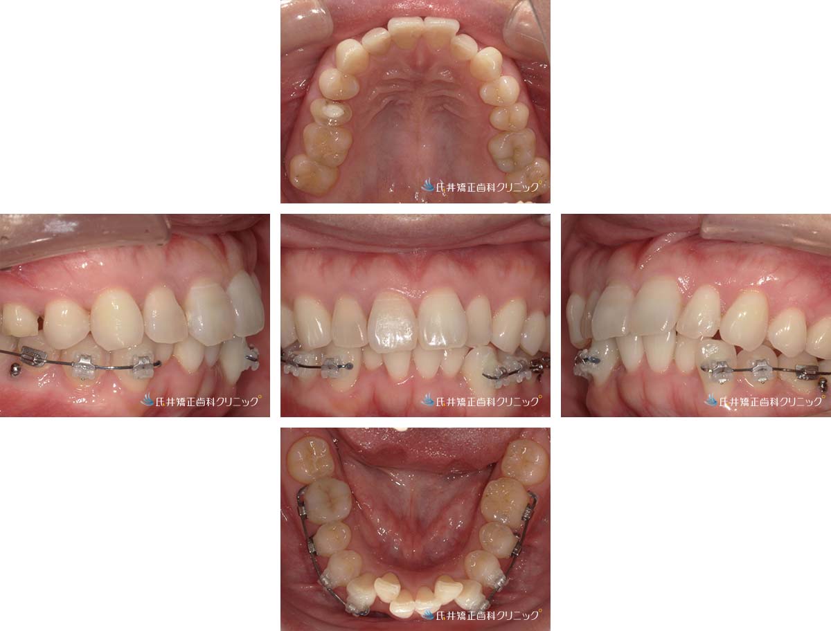 治療中（6ヶ月後）
