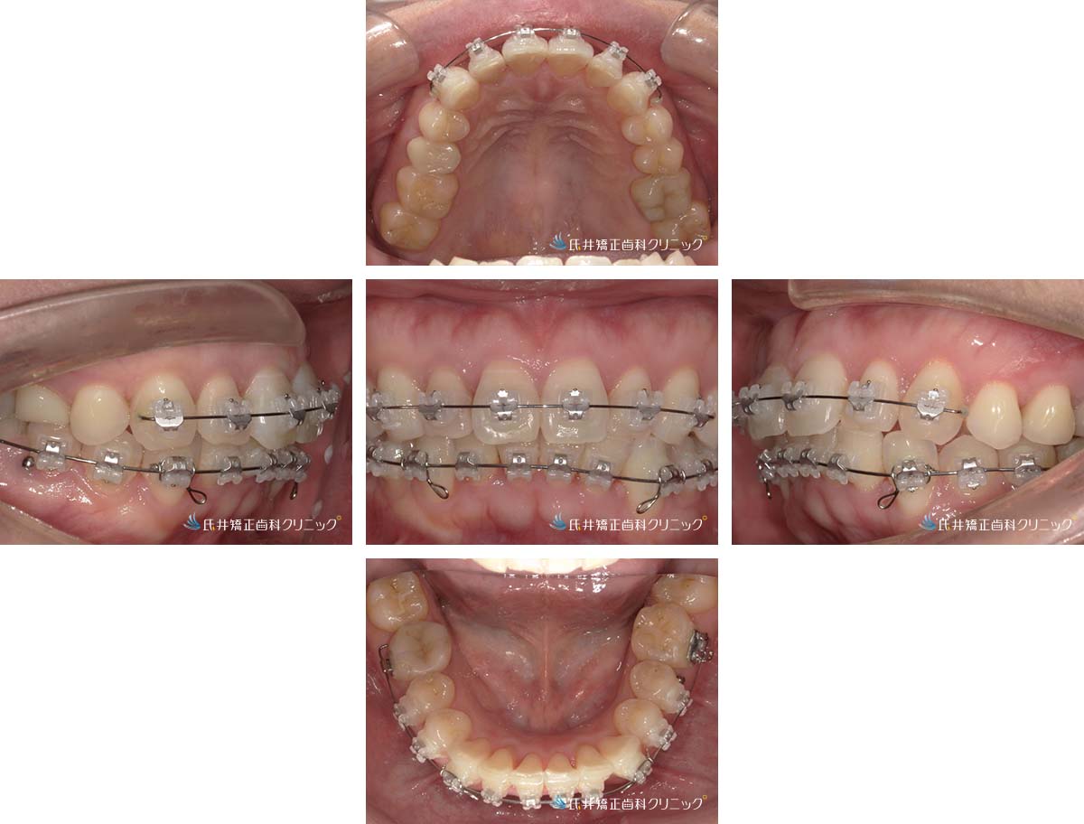 治療中（1年6ヶ月後）