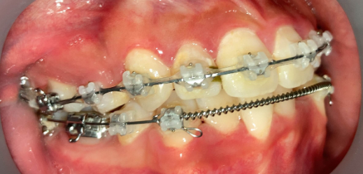 抜歯矯正の隙間閉鎖完了写真｜治療前後の比較｜奈良の矯正歯科