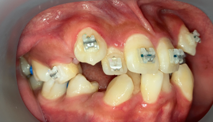 抜歯矯正3週間後の経過写真｜隙間閉鎖の経過｜奈良の矯正歯科