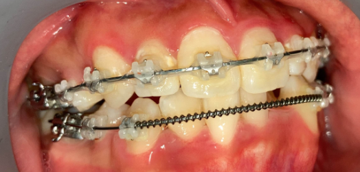 抜歯矯正4ヶ月後の経過写真｜隙間がほぼ閉鎖｜奈良の矯正歯科
