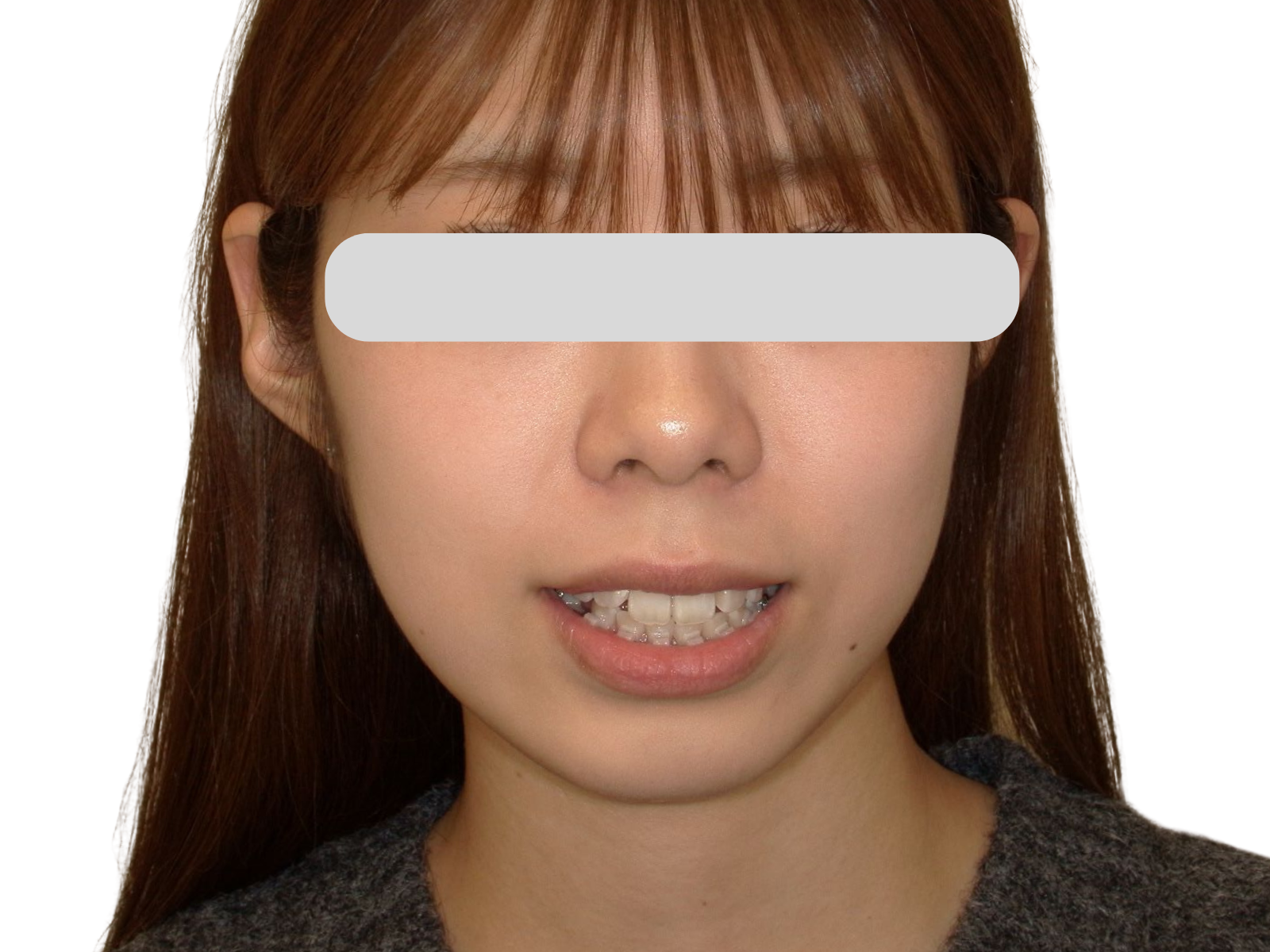 裏側矯正の装着写真