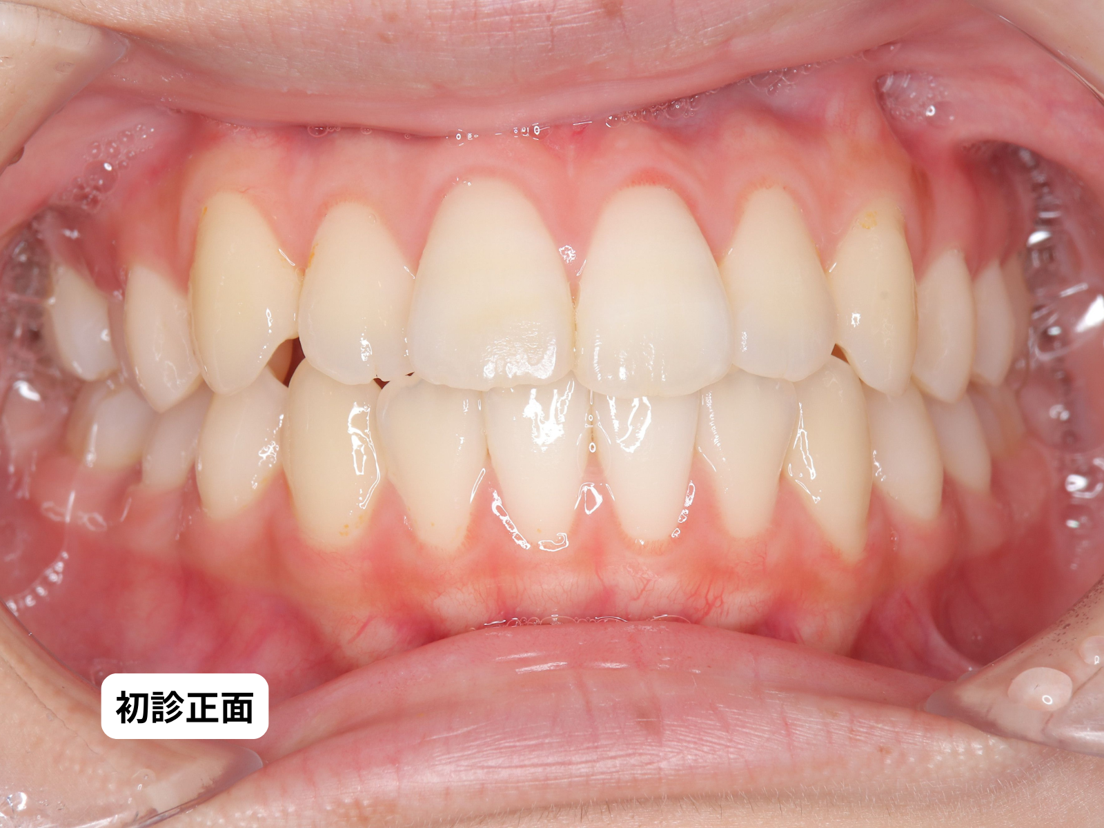 出っ歯・口ゴボ 矯正治療前 口腔内正面｜奈良の矯正歯科 氏井矯正歯科クリニック