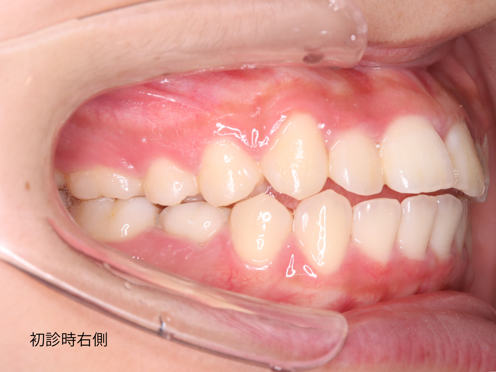 先天性欠如歯 矯正治療前 口腔内右側面｜奈良の矯正歯科 氏井矯正歯科クリニック