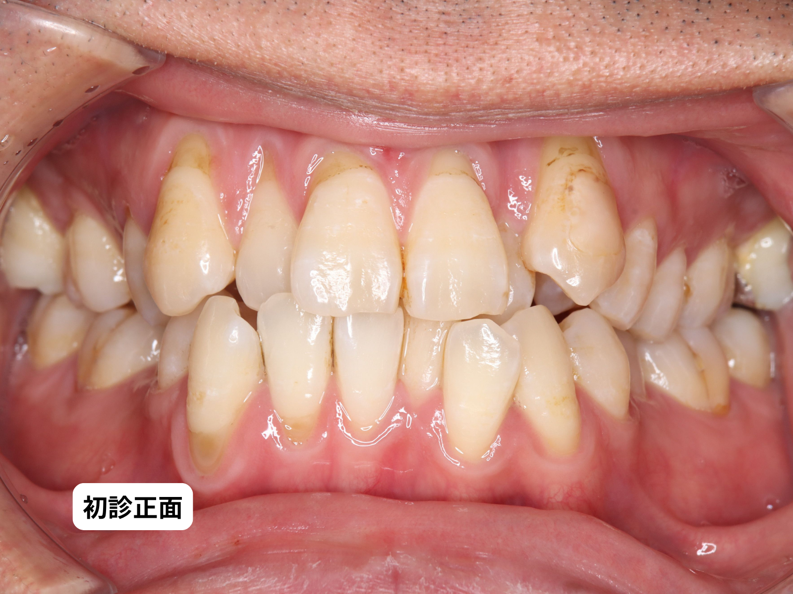 #26-写真1 初診 正面