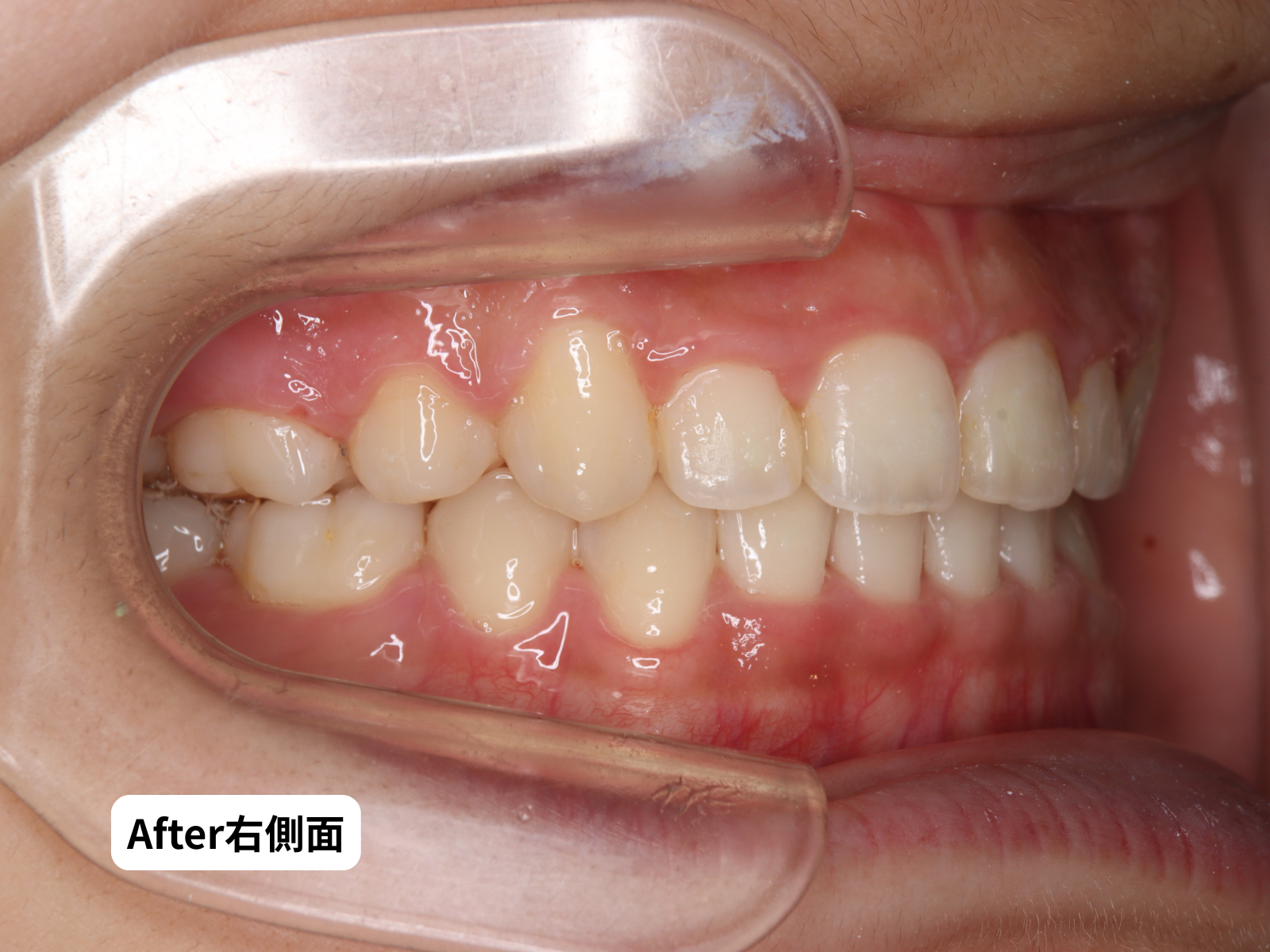 先天性欠如歯 矯正治療後 口腔内右側面｜奈良の矯正歯科 氏井矯正歯科クリニック