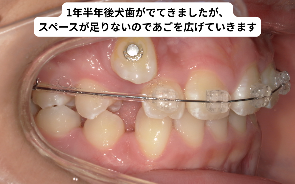開窓牽引により犬歯が萌出｜矯正装置で歯列に並べる段階｜奈良の矯正歯科 氏井矯正歯科クリニック