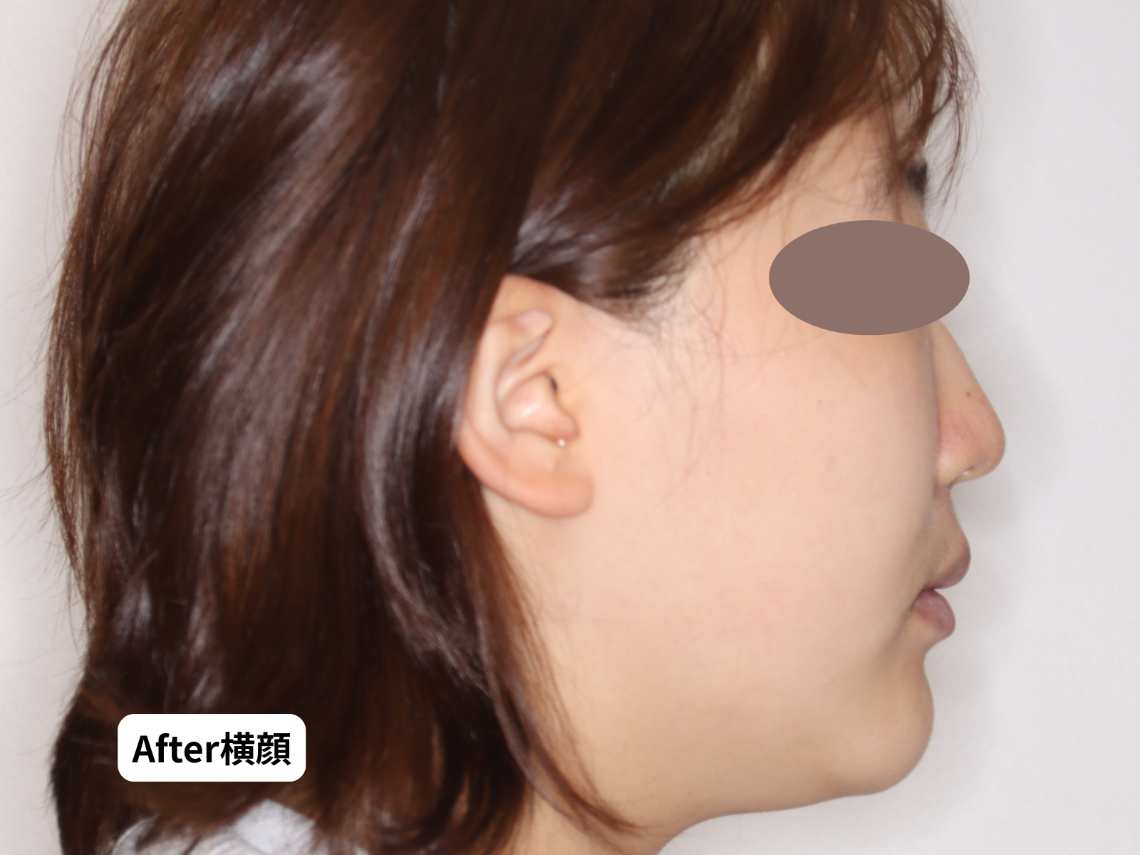 先天性欠如歯 矯正治療後 横顔｜奈良の矯正歯科 氏井矯正歯科クリニック