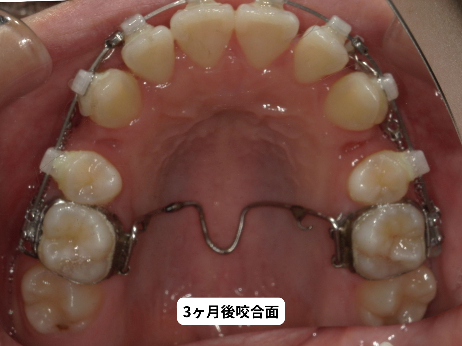 矯正治療3ヶ月後 咬合面｜奈良の矯正歯科 氏井矯正歯科クリニック