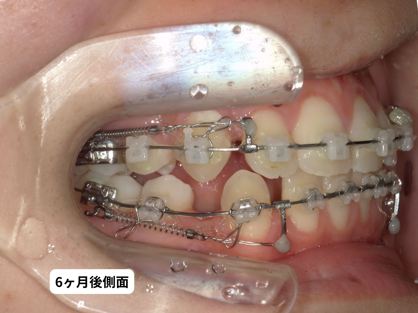 矯正治療6ヶ月後 右側面｜奈良の矯正歯科 氏井矯正歯科クリニック