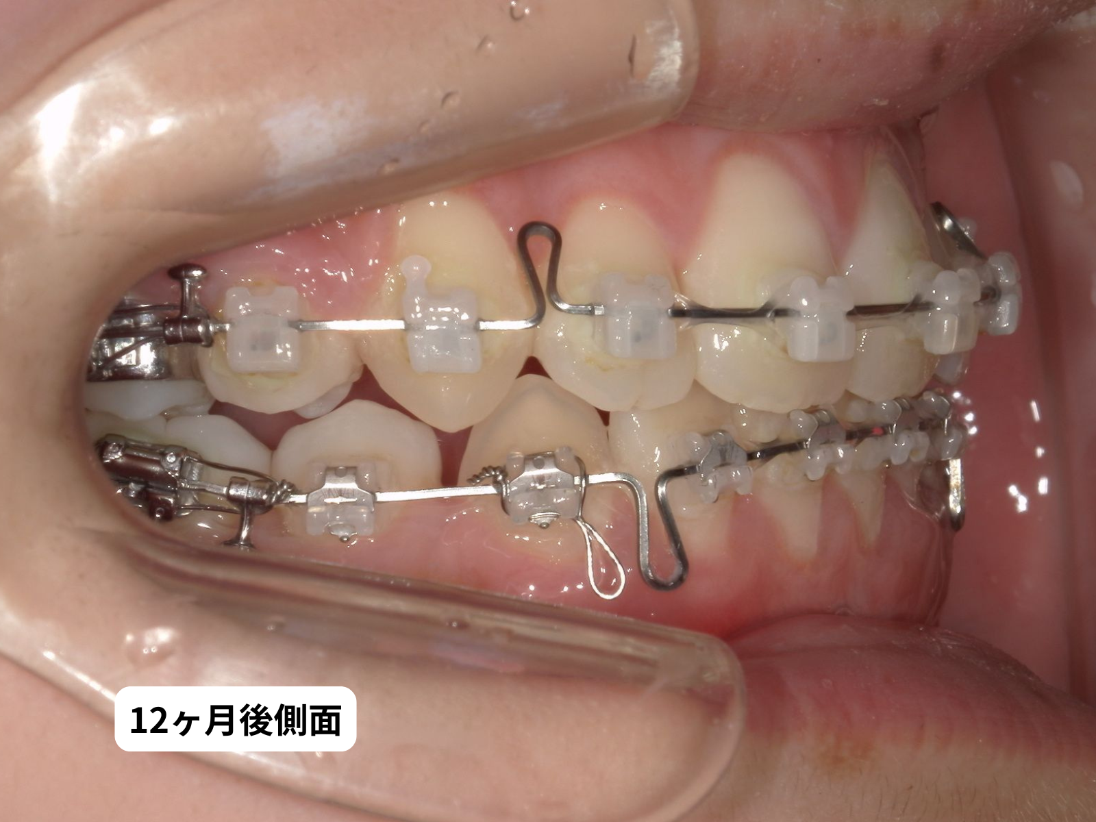 矯正治療12ヶ月後 右側面｜奈良の矯正歯科 氏井矯正歯科クリニック