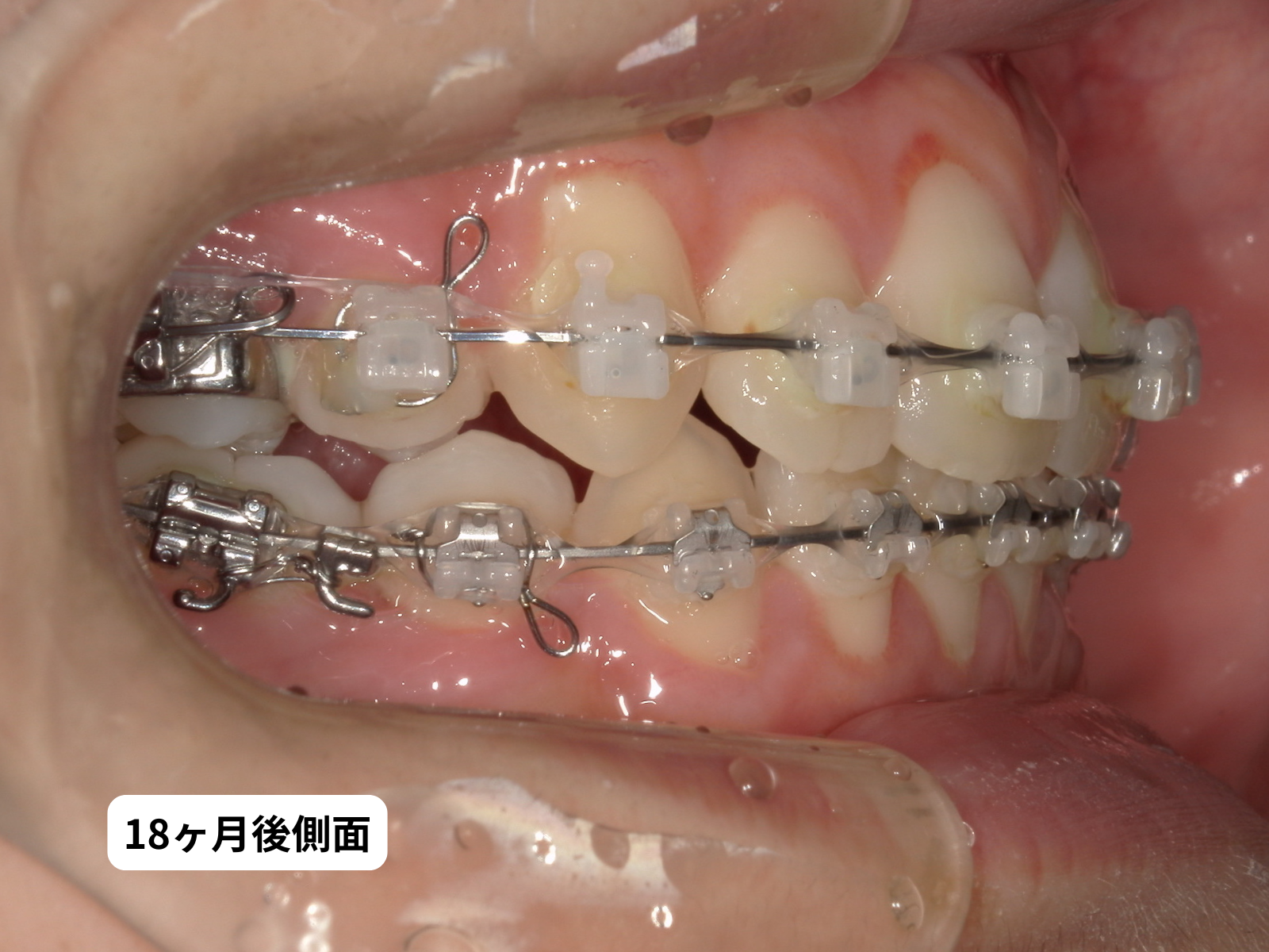 矯正治療18ヶ月後 右側面｜奈良の矯正歯科 氏井矯正歯科クリニック