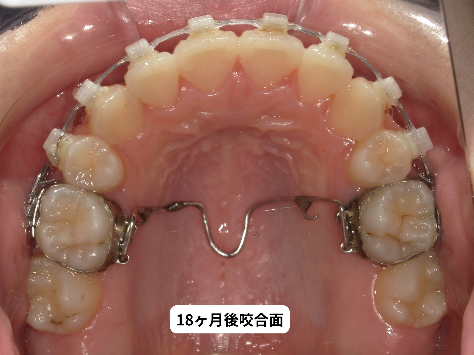 矯正治療18ヶ月後 咬合面｜奈良の矯正歯科 氏井矯正歯科クリニック