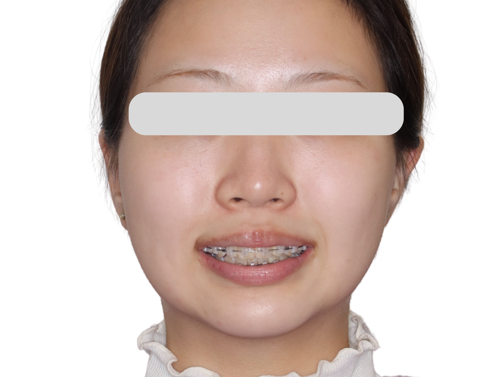 表側矯正（クリアブラケット）の装着写真