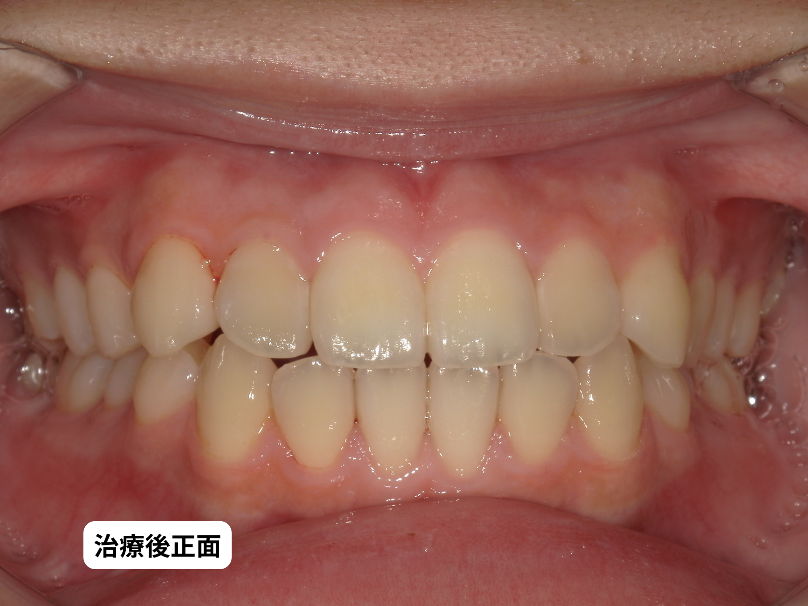 出っ歯・口ゴボ 矯正治療後 口腔内正面｜奈良の矯正歯科 氏井矯正歯科クリニック