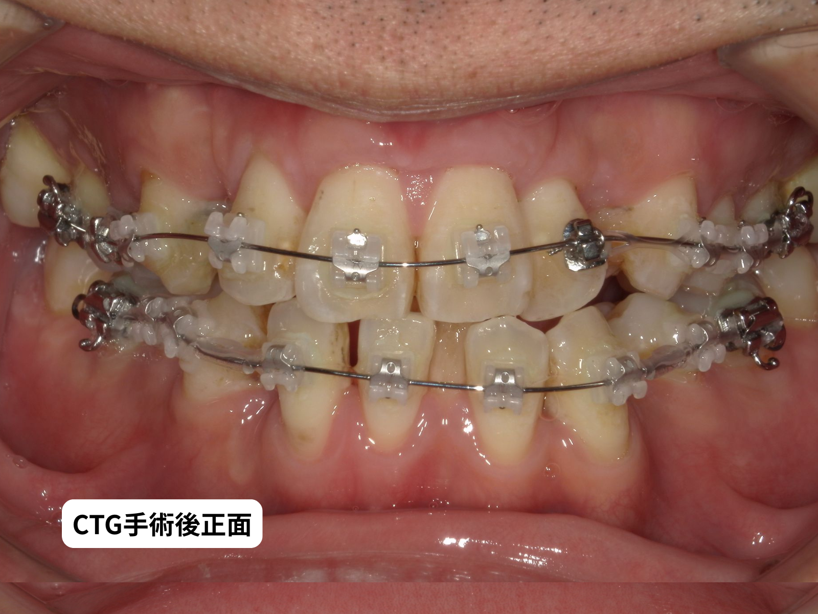 #26-写真2 CTG後 正面