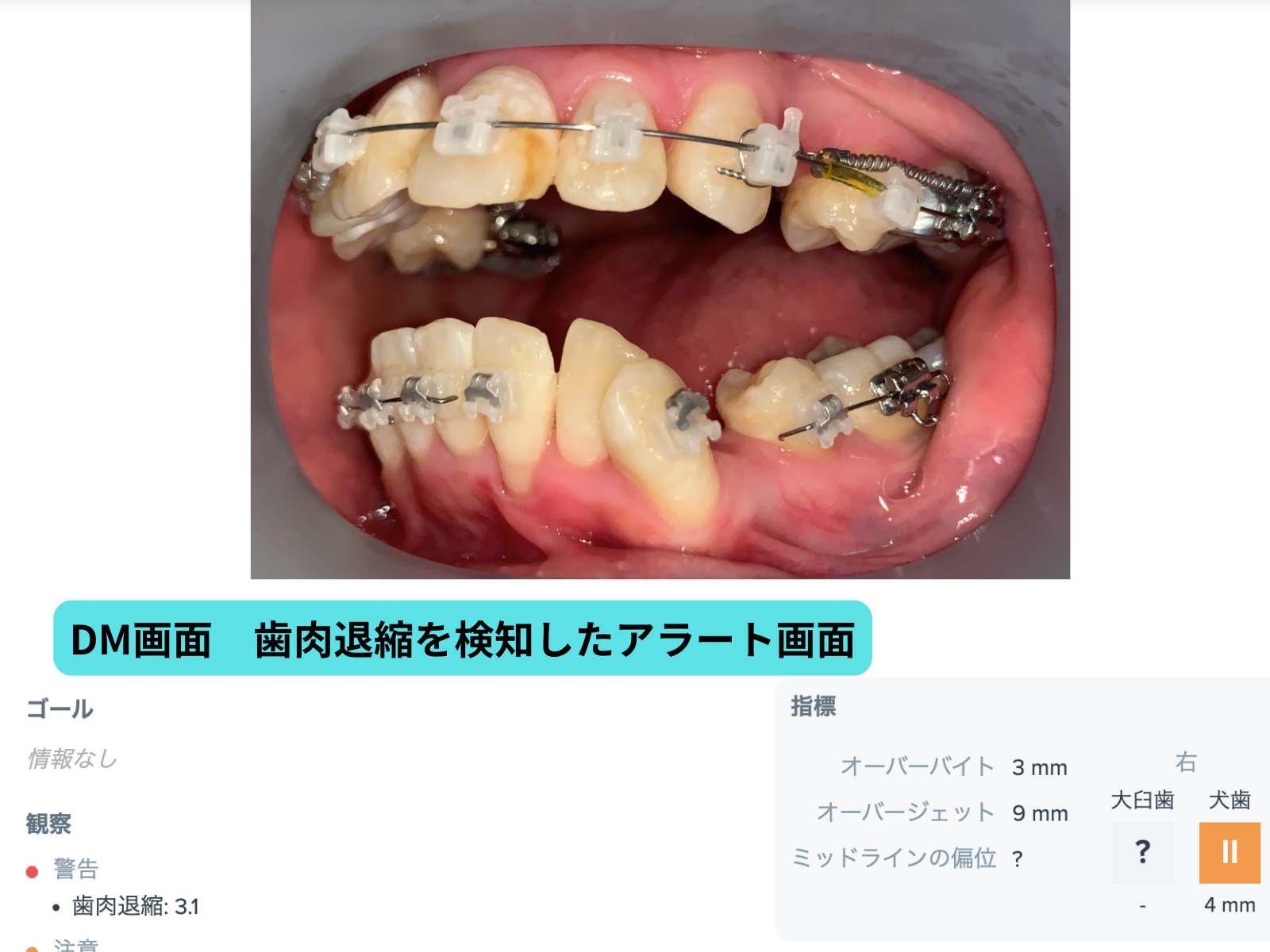 #26-写真8 DM退縮検知