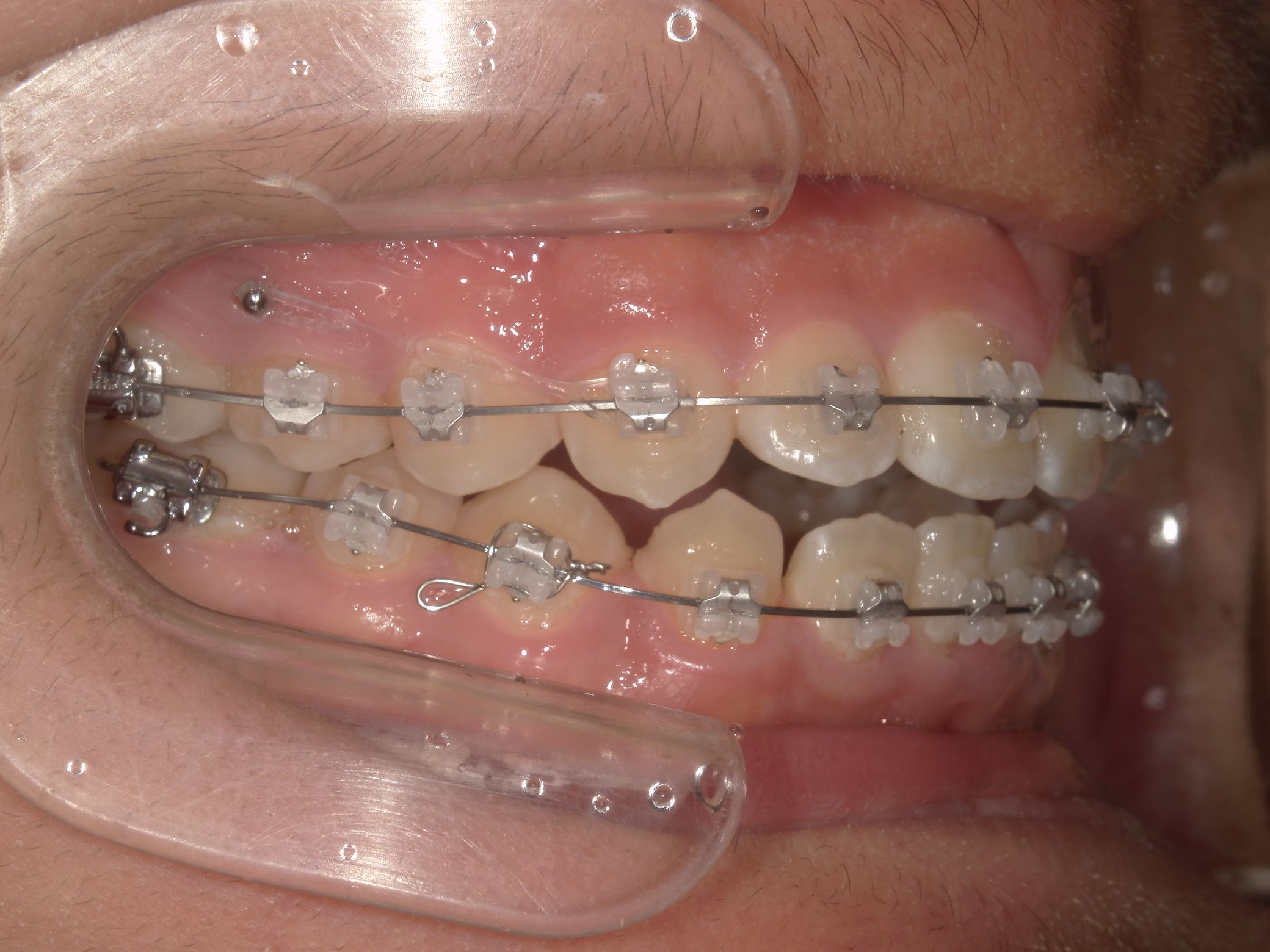 インプラントアンカー装着中の矯正治療経過｜奈良の矯正歯科