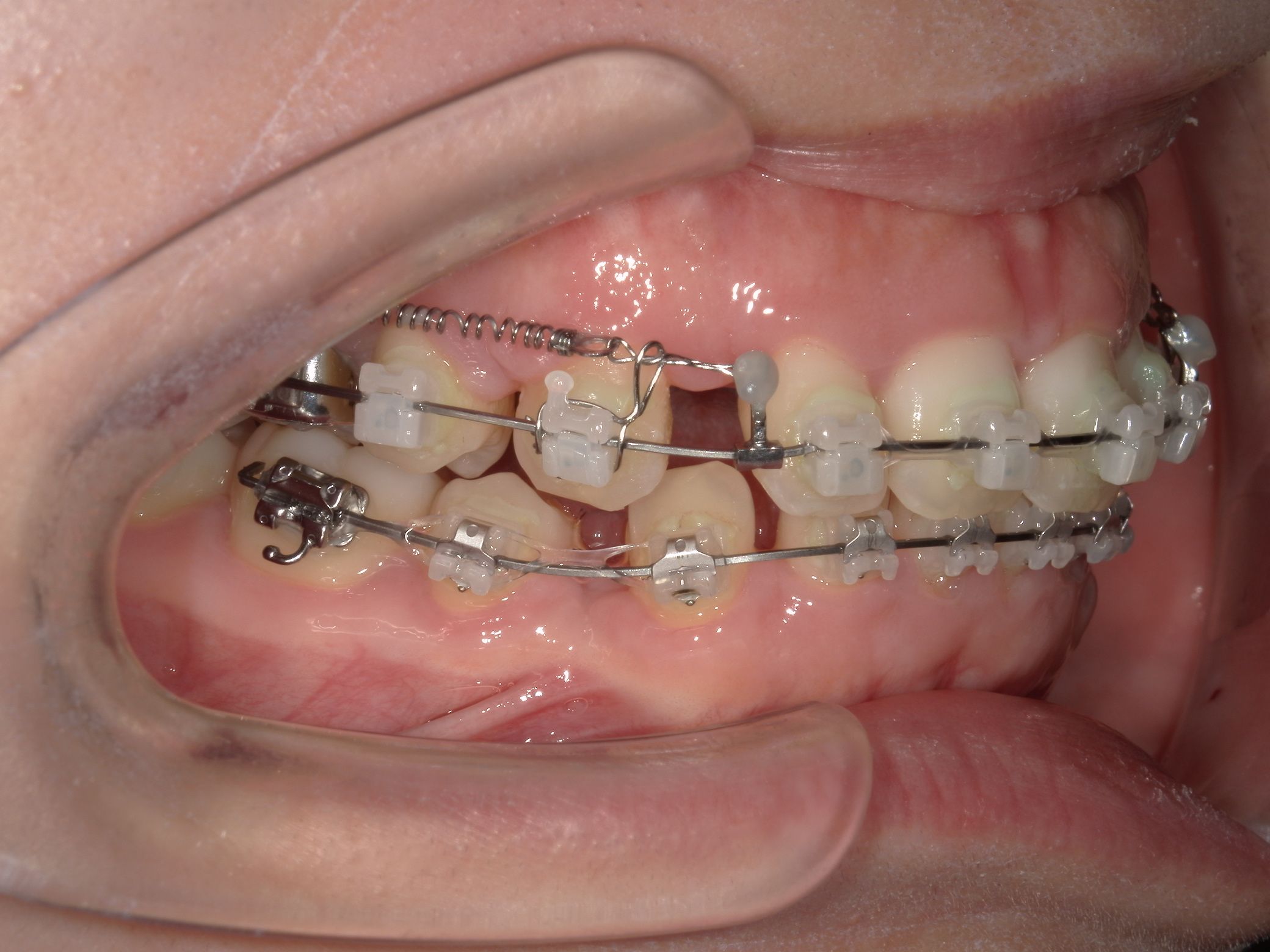 抜歯矯正1年後の口腔内｜奈良の矯正歯科