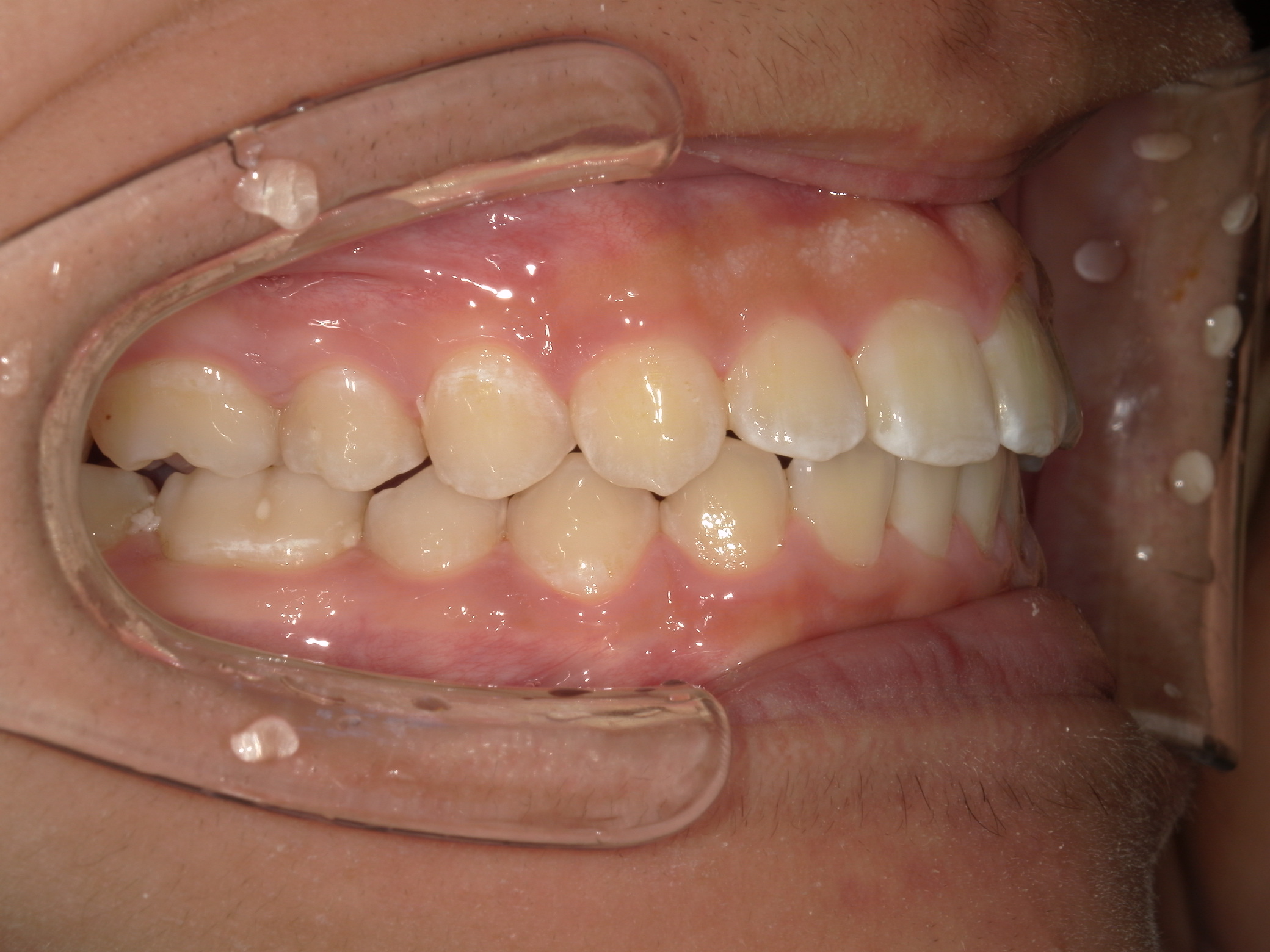 非抜歯アンカー矯正の治療完了｜奈良の矯正歯科