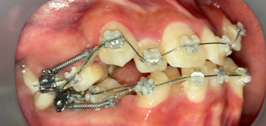 抜歯矯正1週間後の経過写真｜隙間閉鎖の経過｜奈良の矯正歯科