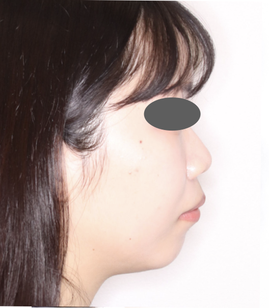 リカバリー症例の初診時｜口元の突出｜奈良の矯正歯科