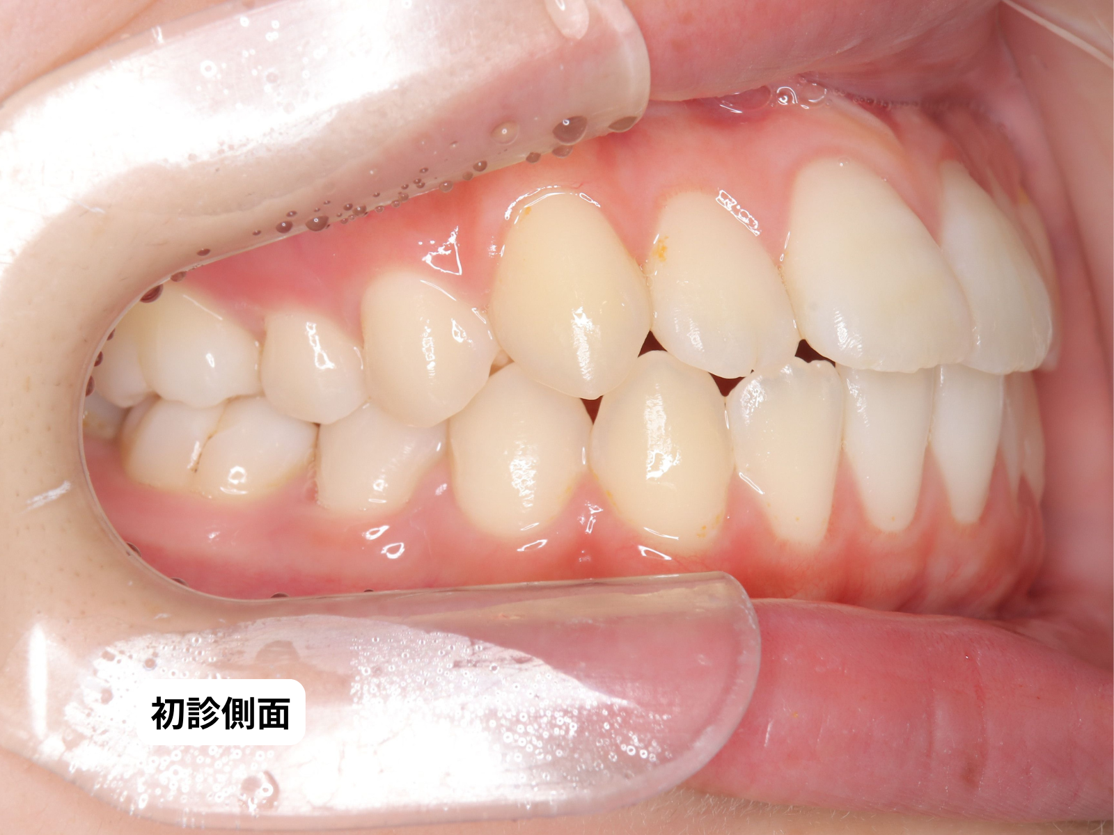出っ歯・口ゴボ 矯正治療前 口腔内側面｜奈良の矯正歯科 氏井矯正歯科クリニック