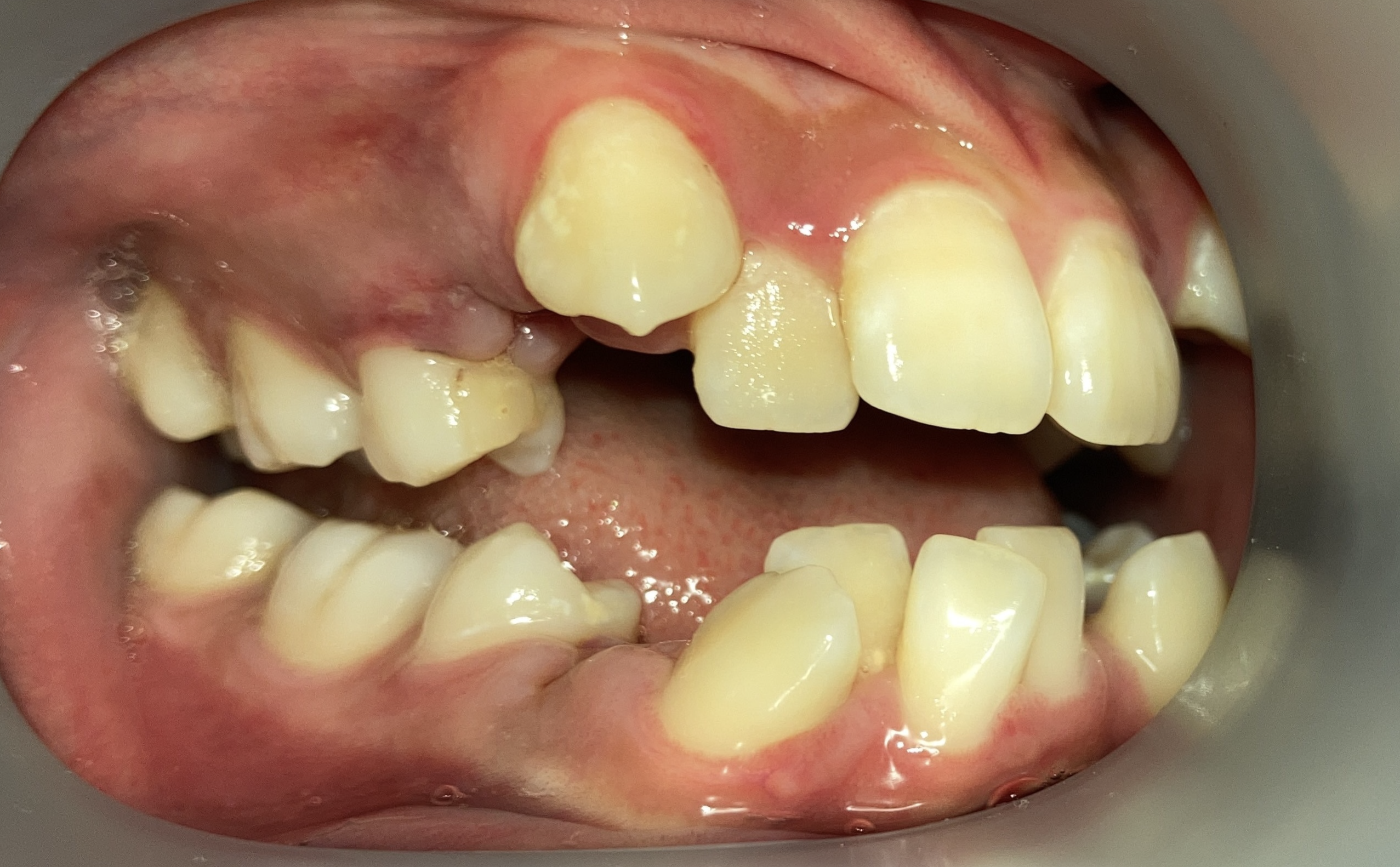 矯正の抜歯直後の口腔内写真｜小臼歯抜歯後の隙間｜奈良の矯正歯科