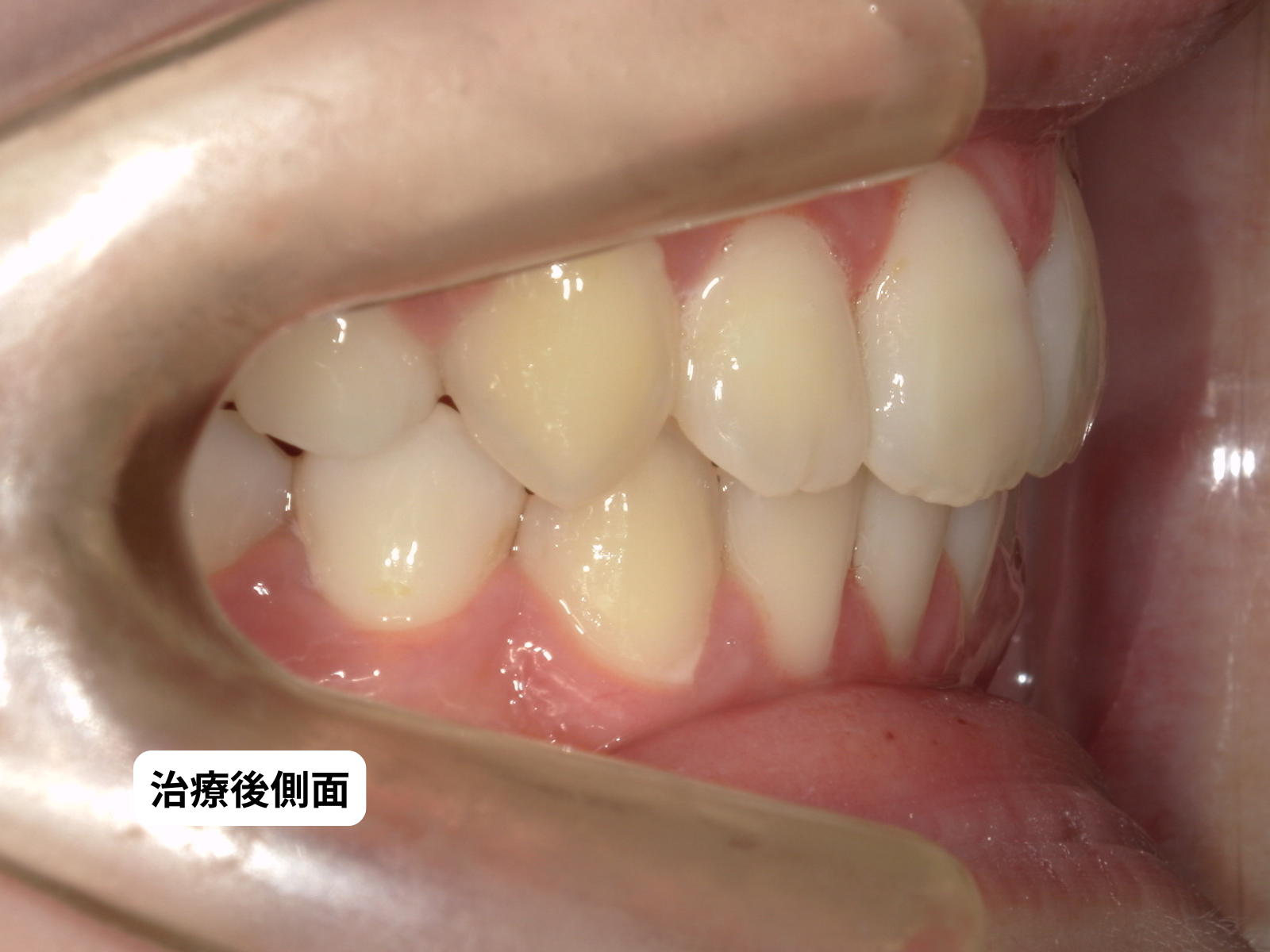 出っ歯・口ゴボ 矯正治療後 口腔内側面｜奈良の矯正歯科 氏井矯正歯科クリニック