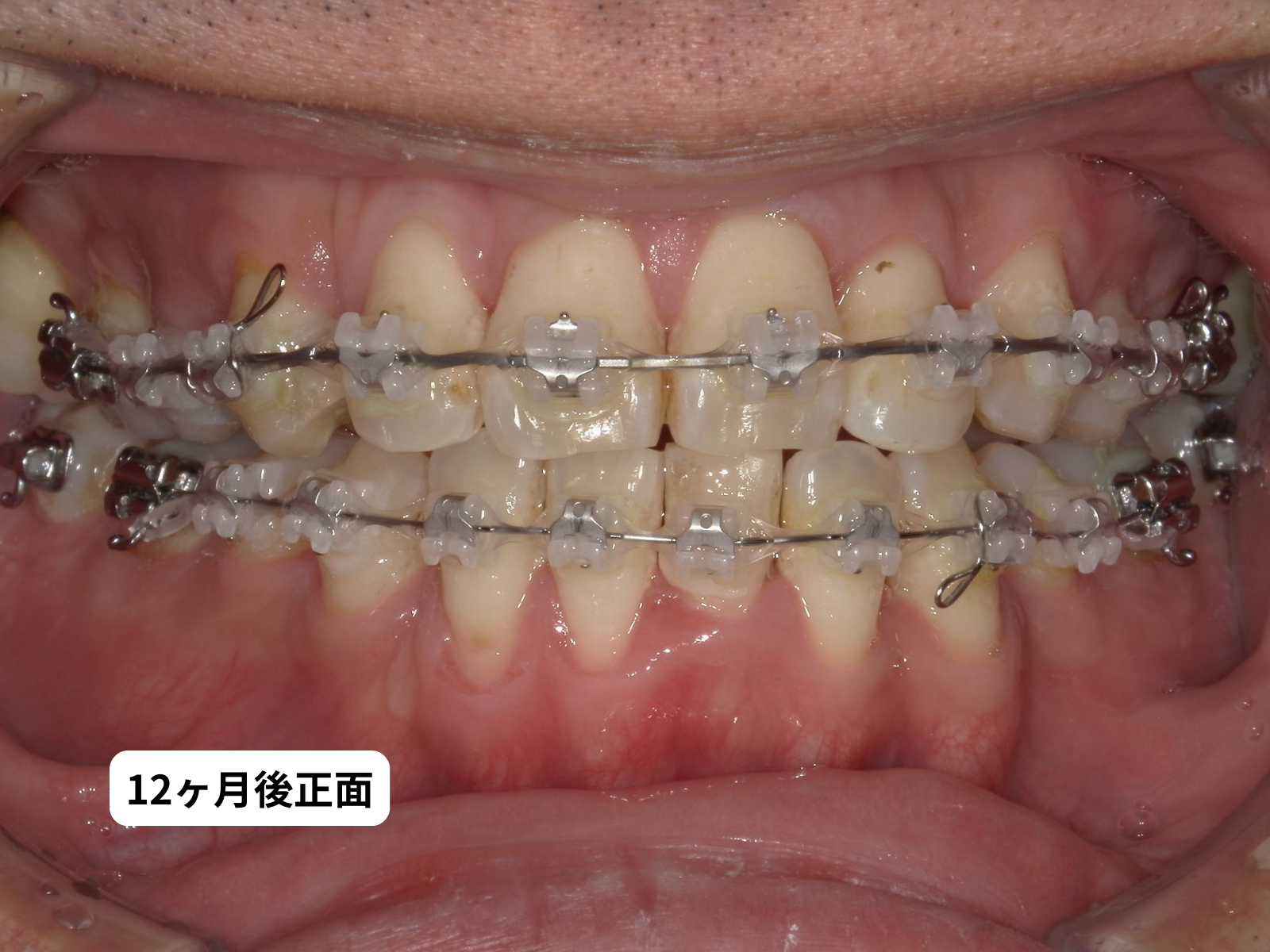 #26-写真4 矯正中 正面