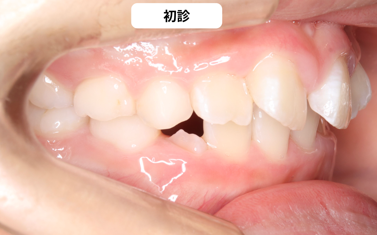 埋伏犬歯の初診時口腔内写真｜奈良の矯正歯科 氏井矯正歯科クリニック