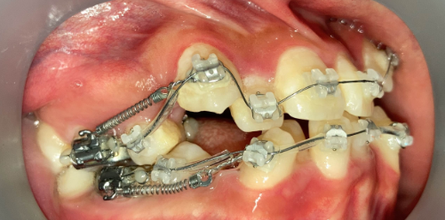 抜歯矯正1ヶ月後の経過写真｜隙間が縮小｜奈良の矯正歯科