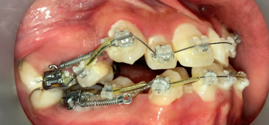 抜歯矯正2ヶ月後の経過写真｜隙間が縮小｜奈良の矯正歯科