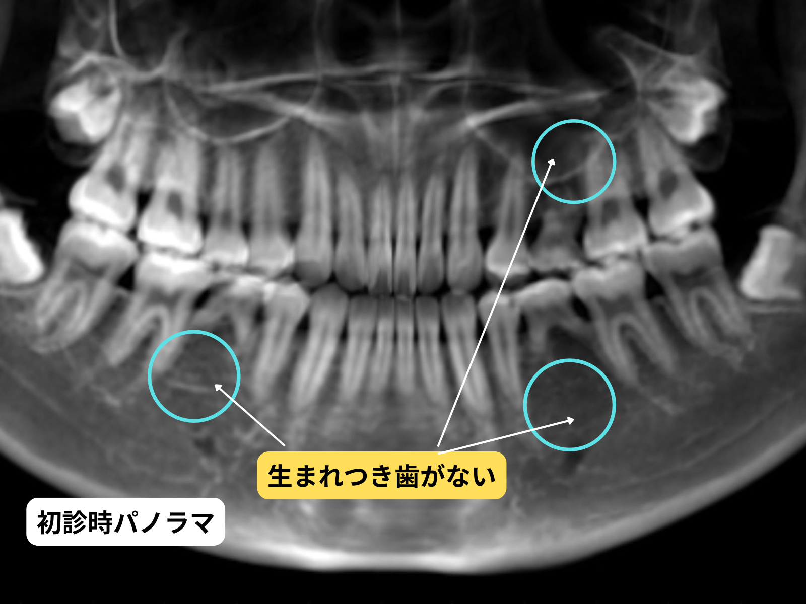 先天性欠如歯のパノラマX線写真｜奈良の矯正歯科 氏井矯正歯科クリニック