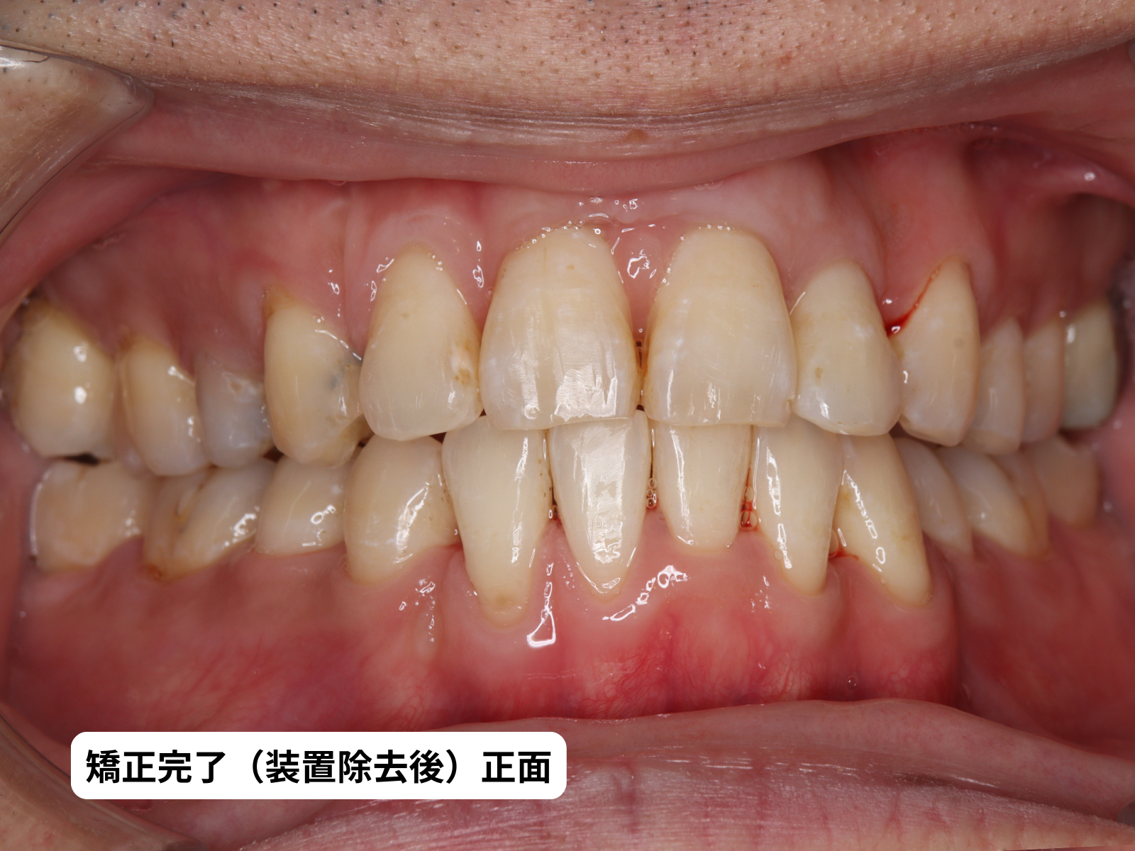 #26-写真5 矯正完了 正面