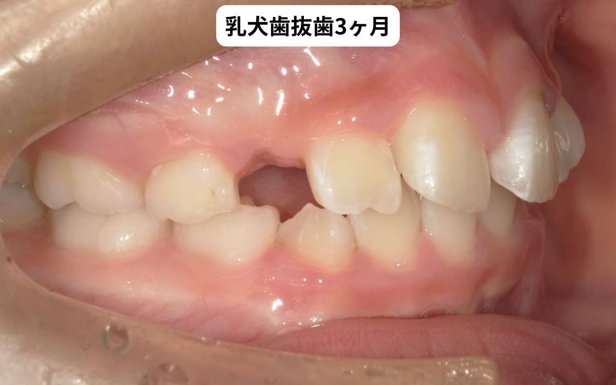乳犬歯抜歯3ヶ月後の経過写真｜犬歯はまだ萌出していない｜奈良の矯正歯科 氏井矯正歯科クリニック