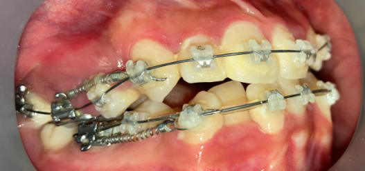 抜歯矯正3ヶ月後の経過写真｜隙間が半分に｜奈良の矯正歯科